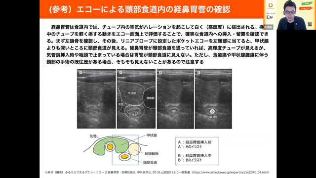 胃瘻、経鼻胃管