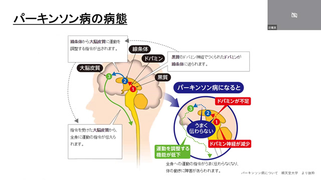 パーキンソン病のイロハ